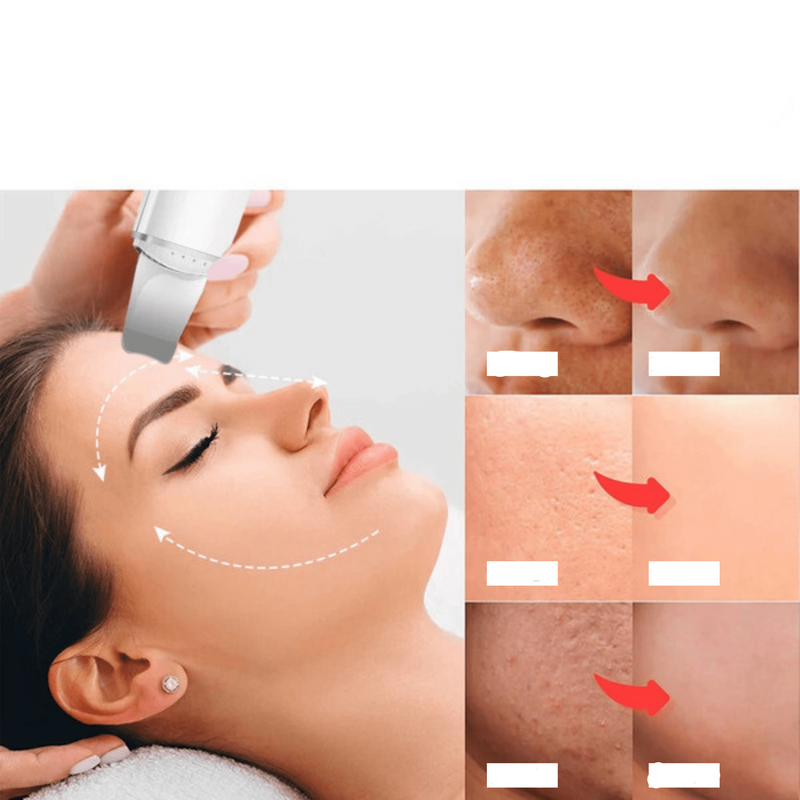 Esfoliador Ultrassônico de Pele - Removedor de Cravos e Limpador Facial com Cavitação